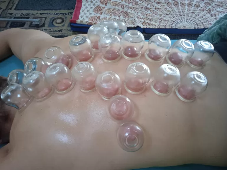 terapia bańkami ogniowymi