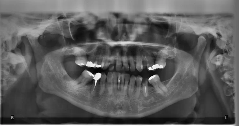 Pantomogram