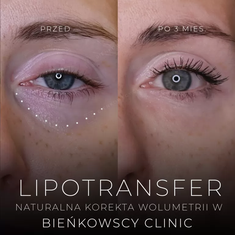 mlode spojrzenie lipotransfer pod oczy bienkowscy clinic
