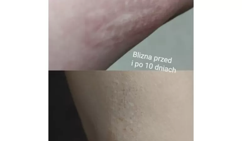 Centrum Usuwania Blizn