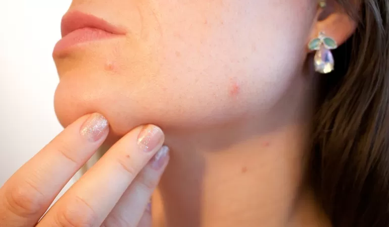 trądzik, dermatolog