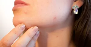 trądzik, dermatolog