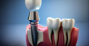 removable partial denture medically accurate toothgenerative ai