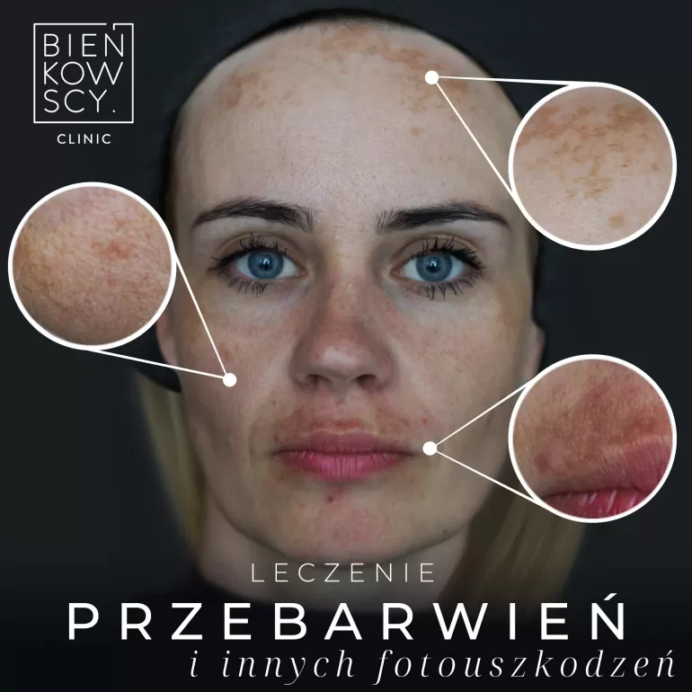 leczenie przebarwien bienkowscy clinic