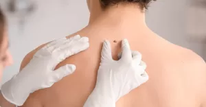 usuwanie znamion